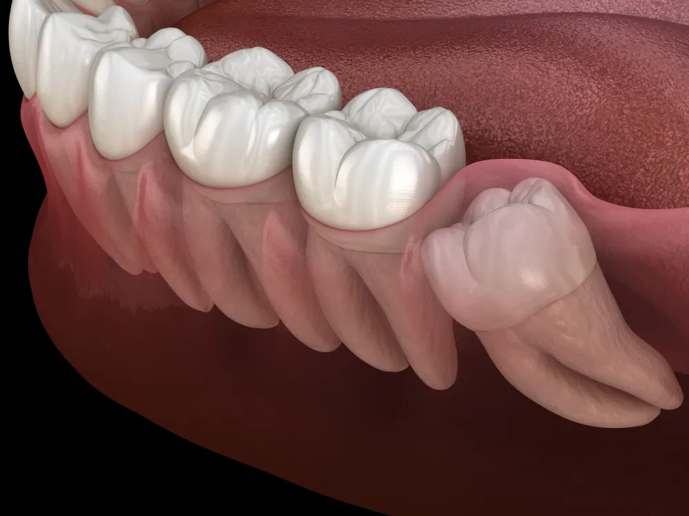 Wisdom Tooth Extraction